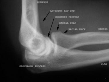 Lateral radiograph of the elbow demonstrates the n