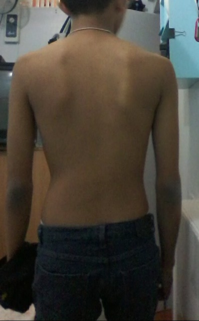 Is it scoliosis?