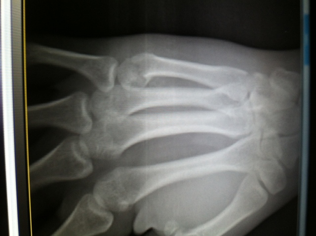 distal metacarpal