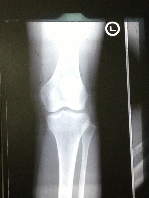 front x-ray of left knee