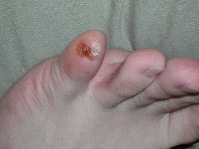 Pinky Toenail