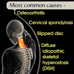 Causes of bone spurs in the neck