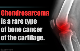 Chondrosarcoma