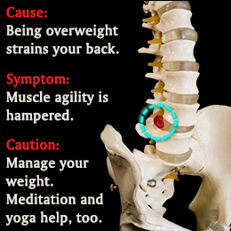Slipped disc cause, symptom, and caution