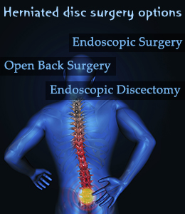 Herniated disc surgery