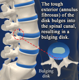 Cause of bulging disk