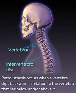 Fact about Retrolisthesis