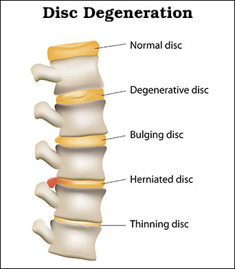 Intervertebral-disc-degeneration