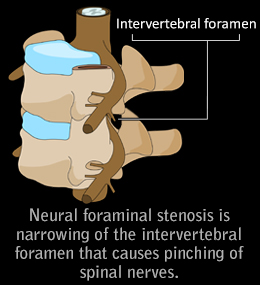 Explaining neural foraminal stenosis
