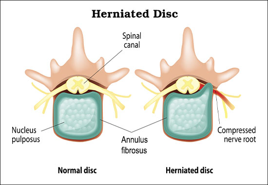 Herniated disc