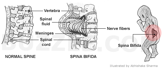 Spina Bifida