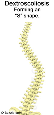 S Shaped Spinal Curve