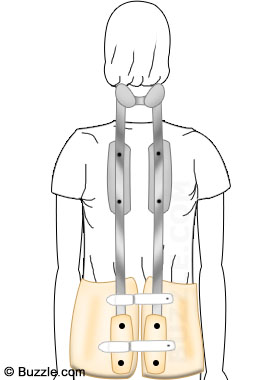 Milwaukee Brace