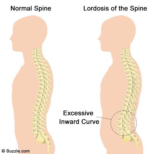Lordosis of the Spine