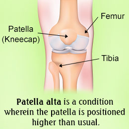 Fact about patella alta