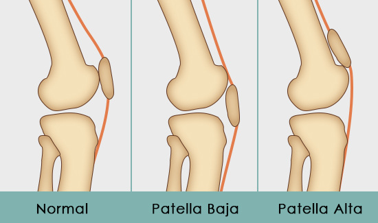 Patella alta