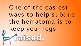 Treating hematoma in legs