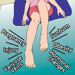 Causes of swollen legs and ankles