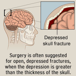 Treatment of skull fracture