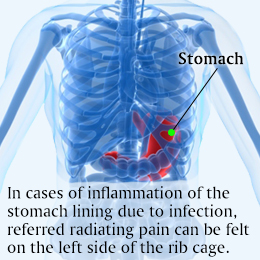 Cause of rib cage pain on left side