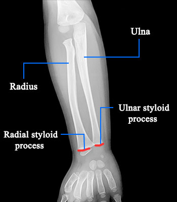 Forearm Bone Structure