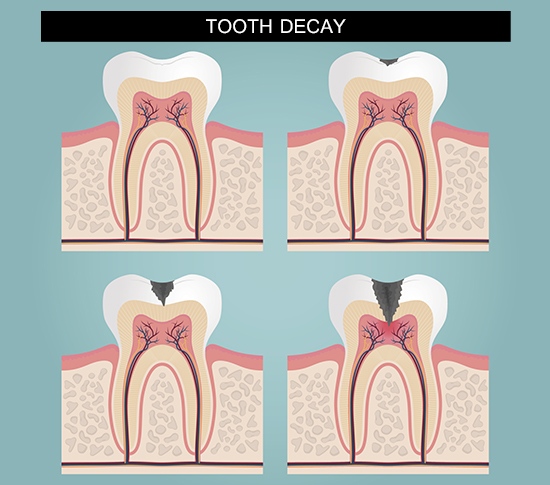 Tooth decay