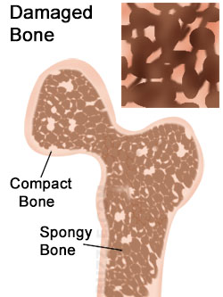 Osteoporosis