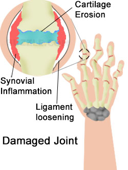 Arthritis