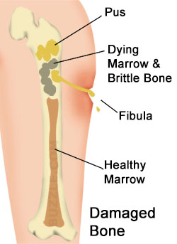 Osteomyelitis