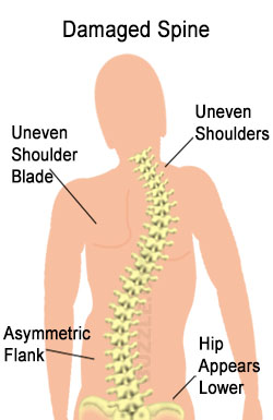 Scoliosis