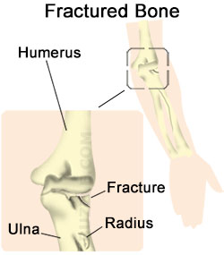 Radial Fracture