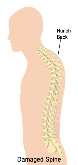 Radial Fracture