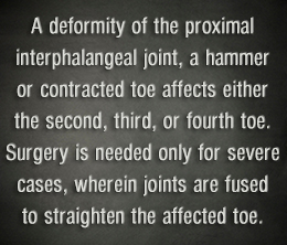 Need of hammertoe surgery