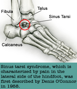 Sinus Tarsi syndrome