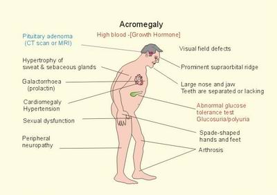 acromegaly