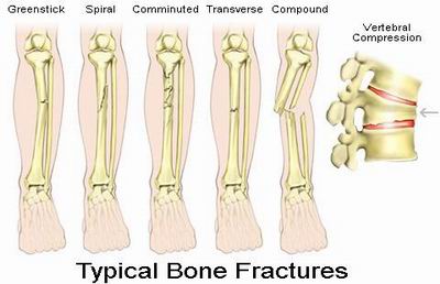 Fractures