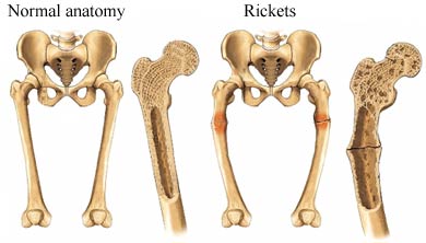 Osteomalacia