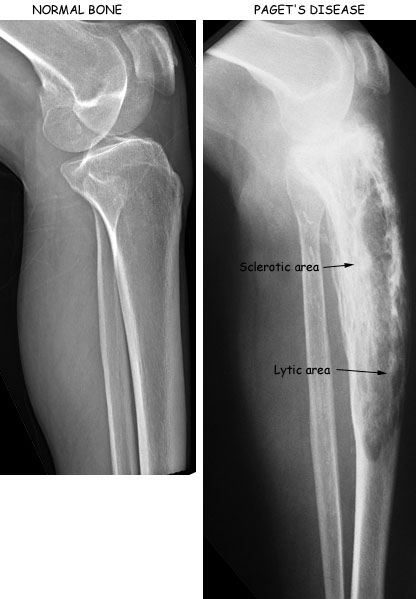 Osteitis deformans