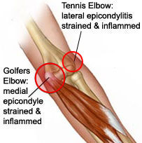 Lateral and medial epicondylitis