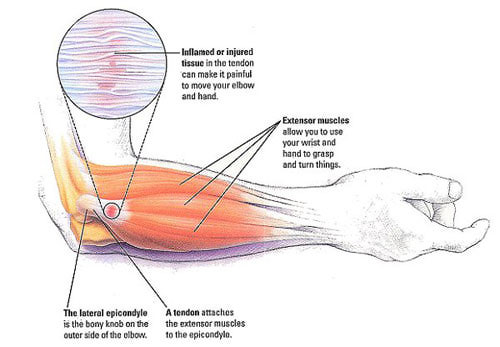 Elbow pain