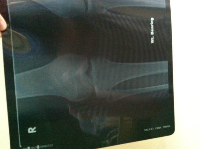 Right knee X ray