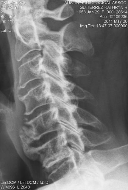 Neck xray