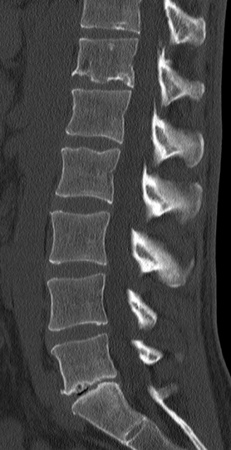 CT Scan L5 S1 