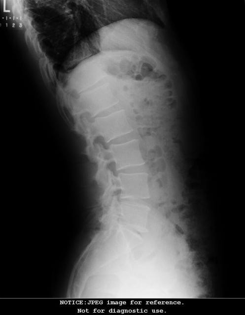 Extension XRay