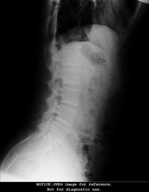 Flexion XRay