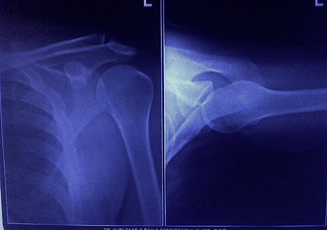 AC Joint XRay