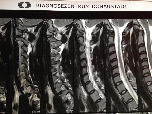 cervical spine