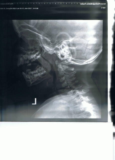Lateral neck x-ray