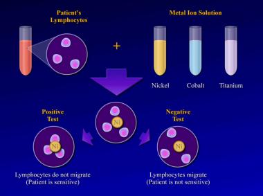 Lymphokine migration test. 