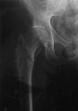 Case example. Image shows the right hip after the 